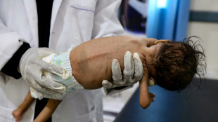 Más de medio millón de niños en Yemen sufren de la forma de malnutrición más mortal, según UNICEF